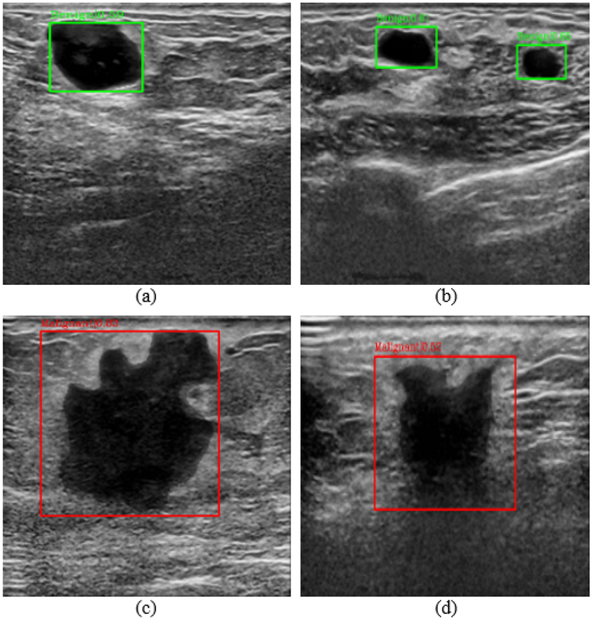 Breast Cancer Ultrasound Analysis